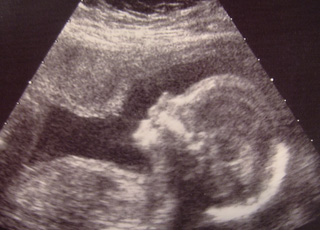 L’embryon est-il une personne humaine ?
